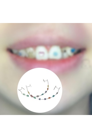 Suntek Arkadaşlar Için Geçici Diş Dekorasyonu Metal Braket