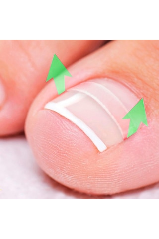 Moveevo Paronişi Düzeltme Aleti Batık Tırnaklar Ve Kıvırcık Tırnaklar Düzeltme Aleti Seti 24 Yama