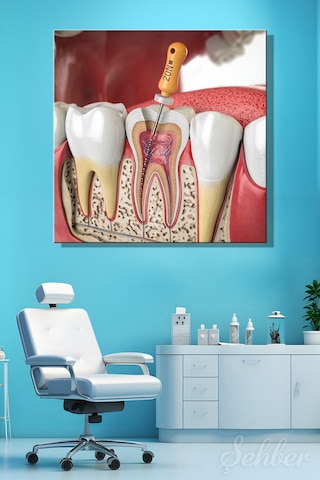 Endodontik Tedavi Kanal Tedavisi Prosedürü 3d Tıbbi İllüstrasyon Yatay Kanvas Tablo 3862 Çok Renkli