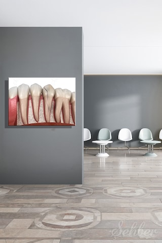 Diş Eti Çene Kemiği Dikey Çatlak Diş Krack Diş 3d Tıbbi İllüstrasyon Kanvas Tablo Yatay Tekli 3669