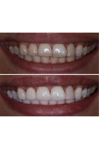 Qartz Diş Temizleme ve Beyazlatma Pastası 200 G