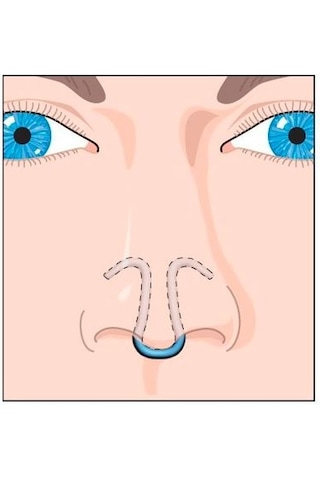 ClipAir Horlama Önleyici Burun Aparatı