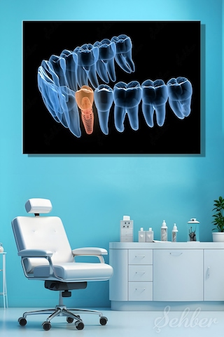 Premolor Dişin İmplant Tedavisi 3d Tıbbi Çizim Yatay Kanvas Tablo Tekli Ağız Diş Sağlığı 3480