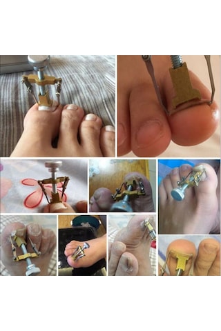 Paslanmaz Çelik Batık Tırnak Çıkartma Aparatı