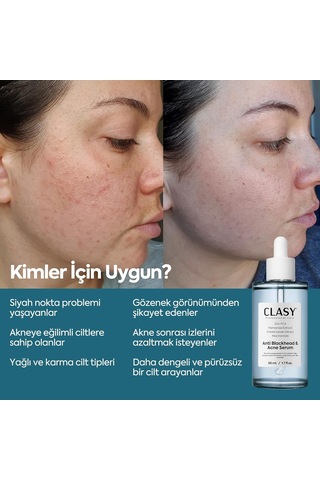 Clasycare Niacinamide Yüz Serumu Gözenek Görünümünü Sıkılaştırmaya Ve Yağ Dengesini Desteklemeye Yardımcı Siyah Nokta Leke Görünümü İçin Aydınlatıcı Bakım Serumu, 50 Ml Sku: Smg8690010455895