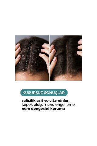 Zento Kepek Karşıtı Saç Bakım Toniği 150 ML