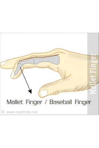 Fixflex Mallet Finger Parmak Ateli No:1