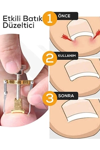 Batık Tırnak Çıkartıcı Orijinal Çelik Batan Tırnağı Düzeltme Aparatı Düzeltici Aleti Çıkarıcı Aparat