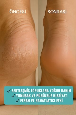 Heél Rescue Çatlak Topuk Yoğun Bakım Balmı 100 Gr, Shea & Çay Ağacı, Doğal Ayak Kremi
