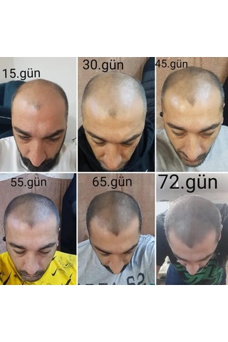 Saç Büyüme Serumu, Hair, 50 Ml, 10'lü Set - Hair