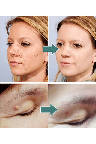 Tenfowee Sauvasıne Doğal Siğil Giderme Yaması - 72 Adet, İnce Ve Şeffaf Cilt Etiketi Temizleme Bandı