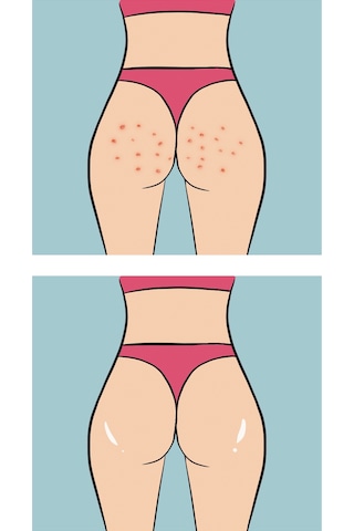 Skin Sensual Buttoks Buttne Vücut Maskesi | Vücut Sivilceleri ve Pürüzlere Karşı | 2 Parça