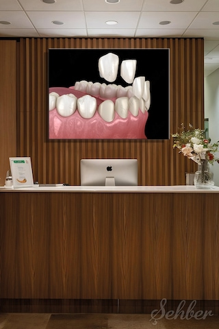 Diş Kaplama Veneer Uygulaması Sürecinin 3 D Aşamaları Tıbbi İllüstrasyon Yatay Kanvas Tekli Tablo 3671