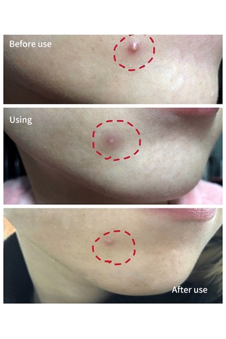 Youtek Breylee Görünmez Sivilce Yama - 22 Adet 12mm+10mm - Doğal Görünüm Sağlar