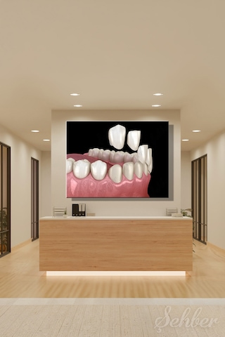 Diş Kaplama Veneer Uygulaması Sürecinin 3 D Aşamaları Tıbbi İllüstrasyon Yatay Kanvas Tekli Tablo 3671