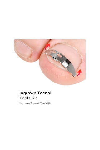 Suofeng Batık Tırnak Düzeltme Seti - Paslanmaz Çelik Tırnak Düzeltici Ve Bant İle Ayak Bakımı