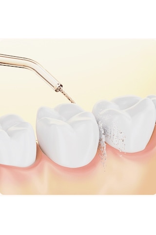 Lichen Diş Taşlarını Çıkarmak İçin Elektrikli Taşınabilir Su İpi