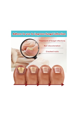 Vkemall South Moon Gece Tırnak Yaması - Mantar, Yumuşak Ve Hasarlı Tırnaklar İçin Onarıcı Bakım 16 Adet