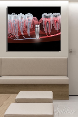 Dental İmplant Tıbbi 3d Çizim Yatay Kanvas Tablo Tekli Ağız Diş Sağlığı Dişçi Poliklinik Hastane 3497