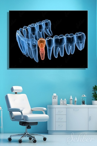 Diş İmplantı Yapay Diş Kökü Tıbbi Ve Anatomik 3 Boyutlu İllüstrasyon Yatay Kanvas Tablo Tekli 3659