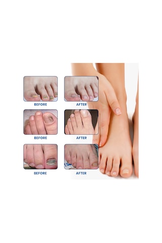 Reedark Tırnak Mantarı İçin 32'li Doğal Bitkisel Yama Seti - Sarımsak Ve Çay Ağacı Yağı İçerir