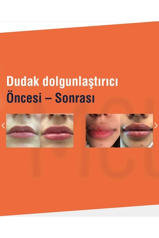 Meleys Bold Plus Plumping Lip Gloss Dudak Dolgunlaştırıcı 0