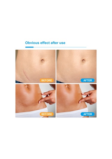 Mufunye Silikon Yara Bandı - Çeşitli Boyutlar Ve Hafif Paket Ağırlığı