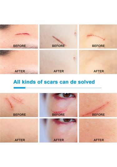 Mufunye Silikon Yara Bandı - Çeşitli Boyutlar Ve Hafif Paket Ağırlığı