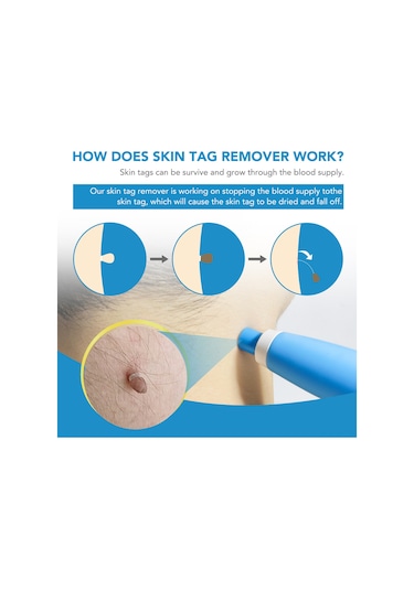 Vkemall Hızlı Ve Etkili Siğil Ve Et Beni Temizleme Seti - 2 Başlık + 40 Lastik Bant 112 Karakter