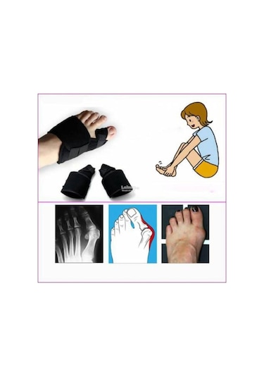 Halluks Valgus Gece Ateli Ayak Baş Parmak Kemik Çıkıntısı