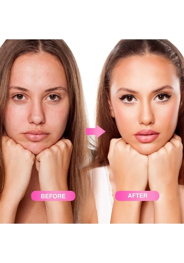 Vkemall Cilt Gençleştirme İğneli Rulo - Kırışıklık Ve İz Giderici Mikro İğne Terapisi 540 İğne, 0.3mm/1.0mm/3.0mm