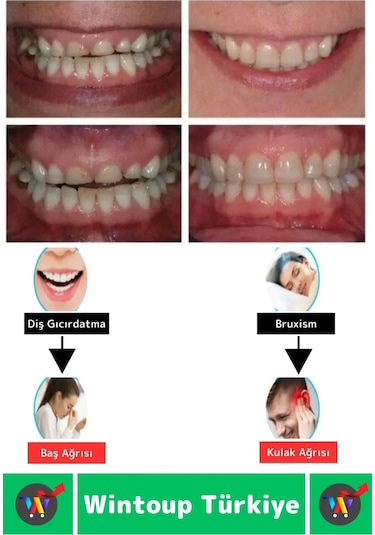 Diş Çene Sıkma Gıcırdatma Bruksizm Önleyici Gece Plağı Koruyucu Uyku Aparatı Protez Kaplı 4 Adet