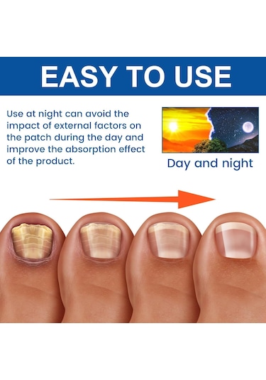 Yifomall 32 Adet Onyxomykoz Ve İçine Giren Tırnak Tamir Bandı - Su Geçirmez, Nefes Alır, Tırnak Büyüme Açısını Düzeltir Bakım Bandı