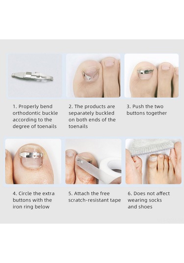 Qingmipy Tırnak Batması Düzeltici Seti - 2 Adet Takılabilir Aparat + Medikal Bant + Tırnak Kaldırıcı