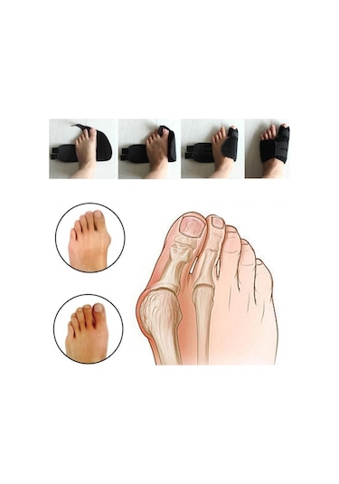 Ankaflex Halluks Valgus Gece Ateli Hallux Başparmak Düzeltici Atel