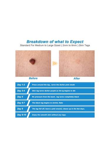 Sones 2'si 1 Arada Otomatik Cilt Eti Çıkarıcı Cihaz Yetişkin Köstebek Siğil Çıkarıcı Yüz Bakımı Güzellik Aletleri