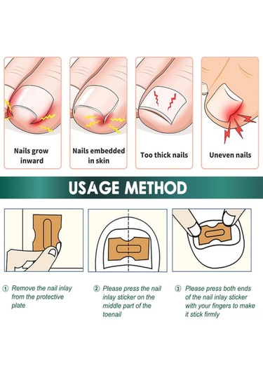 Yifomall 50 Adet Oýnaxan Tırnak Tamiri Seti - Ayak Tırnağı Yumuşatıcı Bandajı, Profesyonel Tırnak Düzeltme Yapistırıcısı