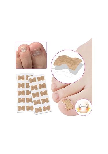 Wezone Nefes Alabilen Tırnak Düzeltme Yapışkanları - 10 Adet 100 Yapışkan, Batık Tırnak Tedavisi İçin Pratik Çözüm