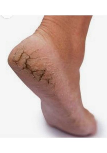 Cilton E Derm Özel Bakim Kremi 50 Ml