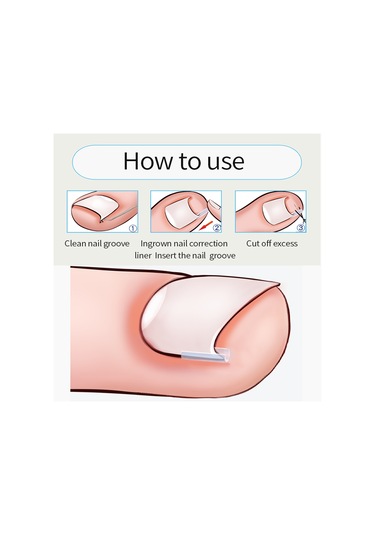 Moveevo Ayak Tırnağı Düzeltme Alet Seti 3 50 Batık Tırnak Düzeltme Pedi, 3 Parçalı Batık Tırnak Alet Seti