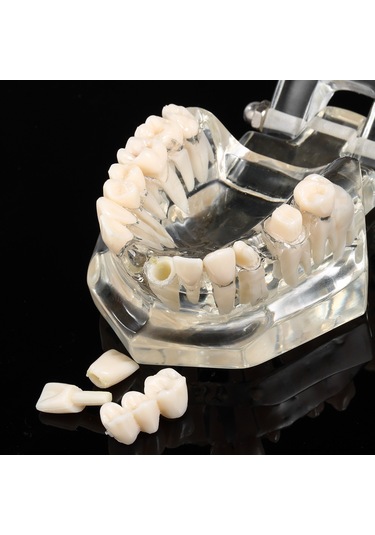 Samdoo Diş Sağlığı Eğitim Modeli: Şeffaf, Ayrılabilir Mandibula Ve Maksila - Diş Yapısı Ve İmplantasyon Öğretimi Çok Renkli