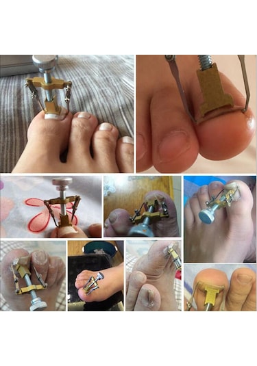 Qingmipy Altıparmak Tırnağı Düzeltme Aracı - İçbükey Tırnak Sorunu Çözücü - Paslanmaz Çelik Altın