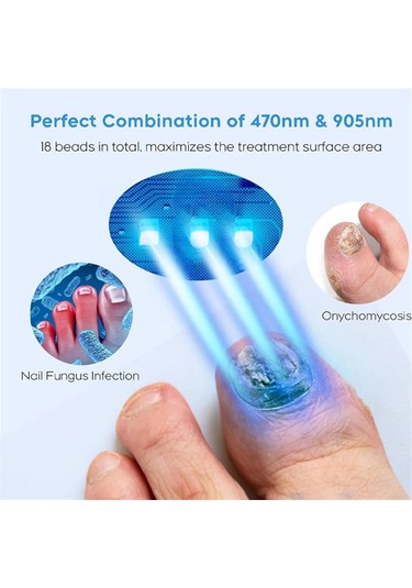 Xurunkeji Adet Mantarlı Tırnak Lazer Cihazı Onarımı Tırnak Tedavisi Mantar Enfeksiyonu Paronişi Onikomikoz Batık Ayak Tırnağı