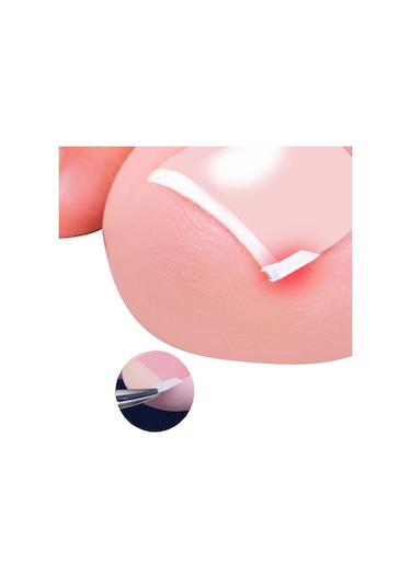 Moveevo Ayak Tırnağı Düzeltme Alet Seti 3 50 Batık Tırnak Düzeltme Pedi, 3 Parçalı Batık Tırnak Alet Seti