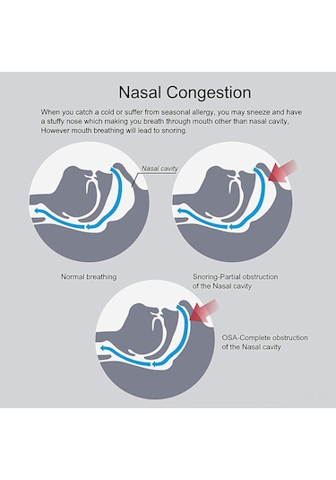 Qingmipy "görünmez Burun Genişletici - Horlamayı Önler, Rahat Nefes Sağlar 3 Adet M Beden "