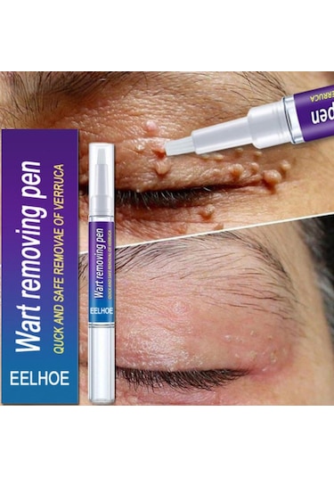 Cilt Etiketi Sökücü Benlere Karşı Tıbbi Ağrısız Hızlı Kaldırma Genital Siğil Akne Leke Tedavisi Papillomlar Düz Siğil Güzellik Sağlık