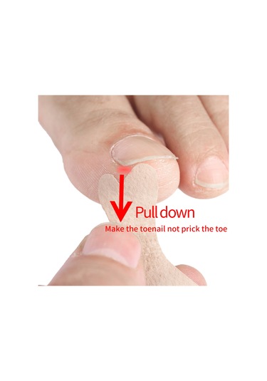 Moveevo Kelebek Şeklinde Batık Tırnak Ters Germe Düzeltme Yaması 36 Yama