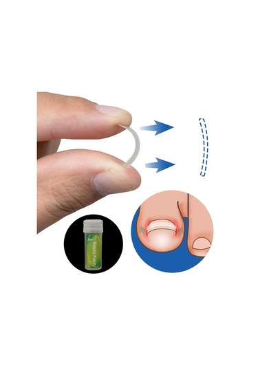 Moveevo Paronişi Düzeltme Aleti Batık Tırnaklar Ve Kıvırcık Tırnaklar Düzeltme Aleti Seti 24 Yama