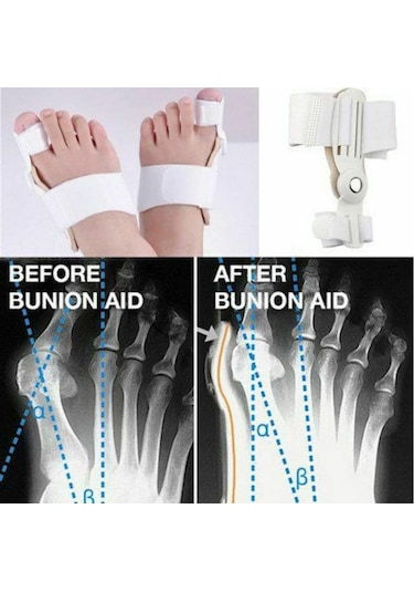 Ayak Başparmak Kemik Düzeltici Halluks Valgus Bunyon Gece Ateli
