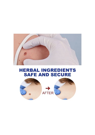 Cilt Etiketi Sökücü Benlere Karşı Tıbbi Ağrısız Hızlı Kaldırma Genital Siğil Akne Leke Tedavisi Papillomlar Düz Siğil Güzellik Sağlık